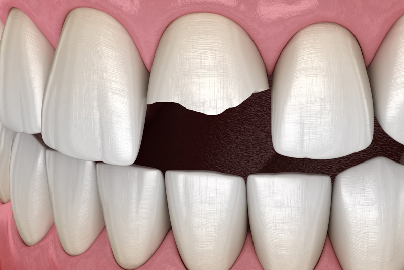 Chipped tooth example model