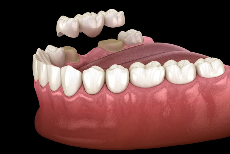 Crown and bridge example model