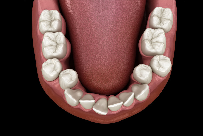 Crooked teeth example model