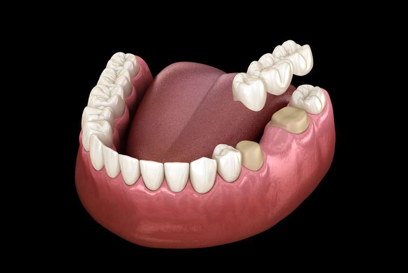 Crown and bridge example model