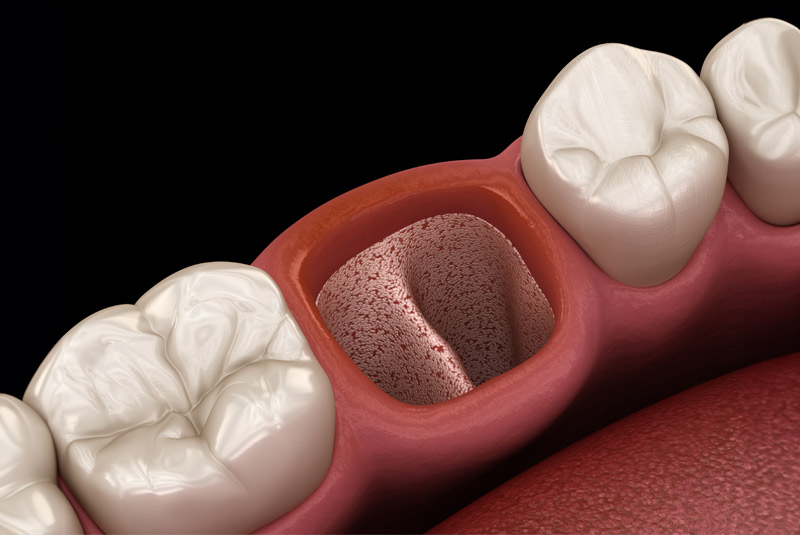 Tooth extraction example model