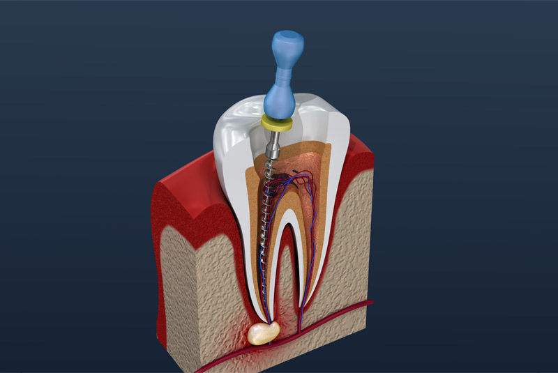 Root canal example model