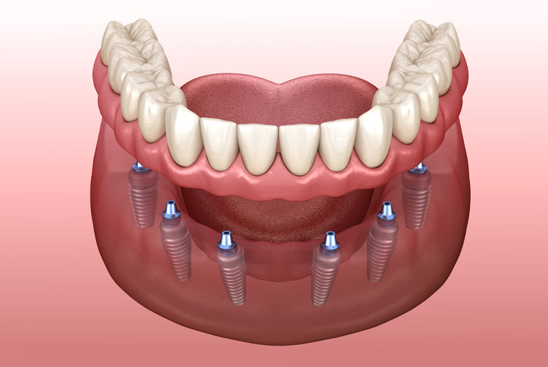 Implant supported dentures example model