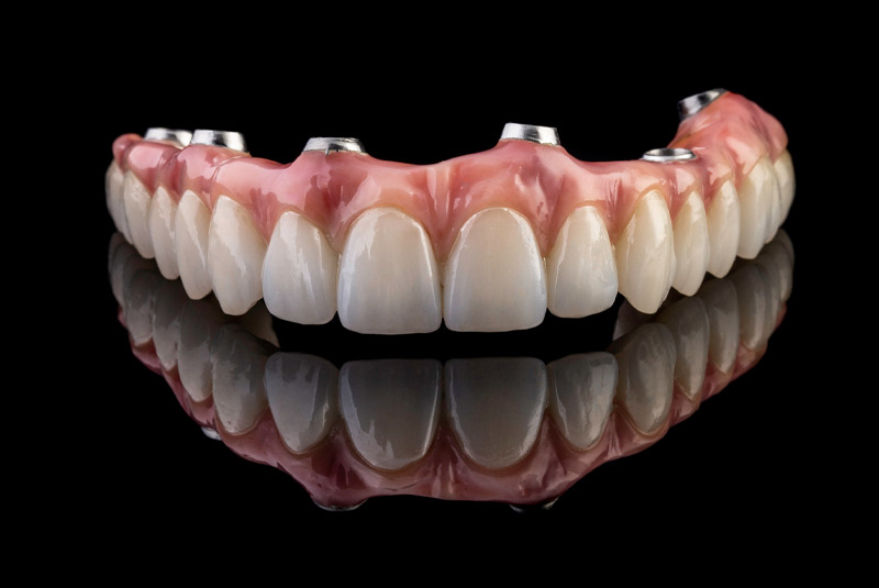 Full mouth dental implants