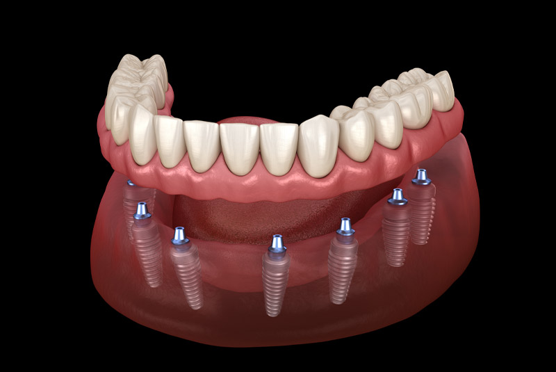 Implant supported dentures example model