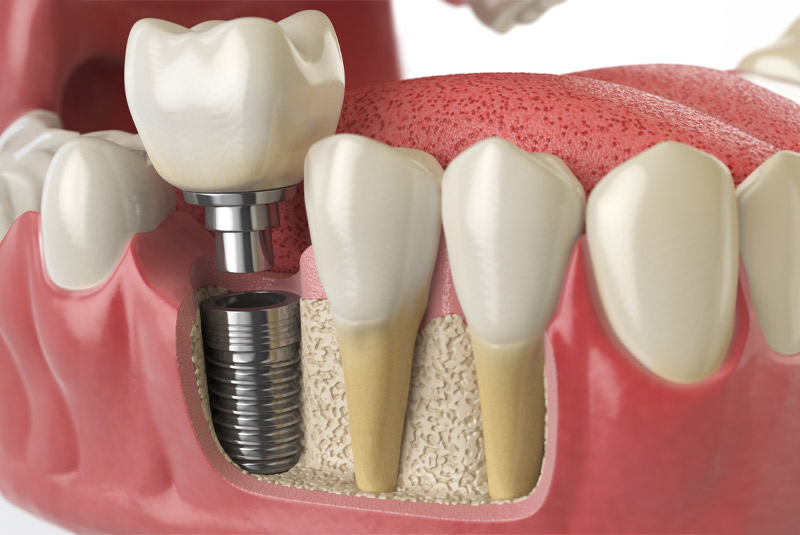 Dental implant example model