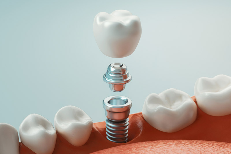 Dental Implant Example model
