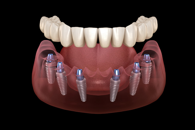 Full mouth dental implants
