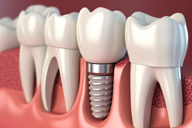 Dental implant example model