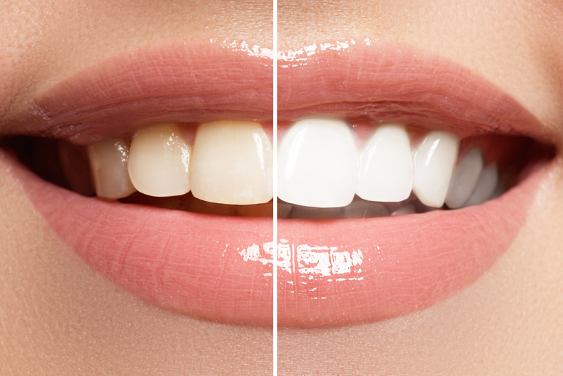 Teeth whitening example model