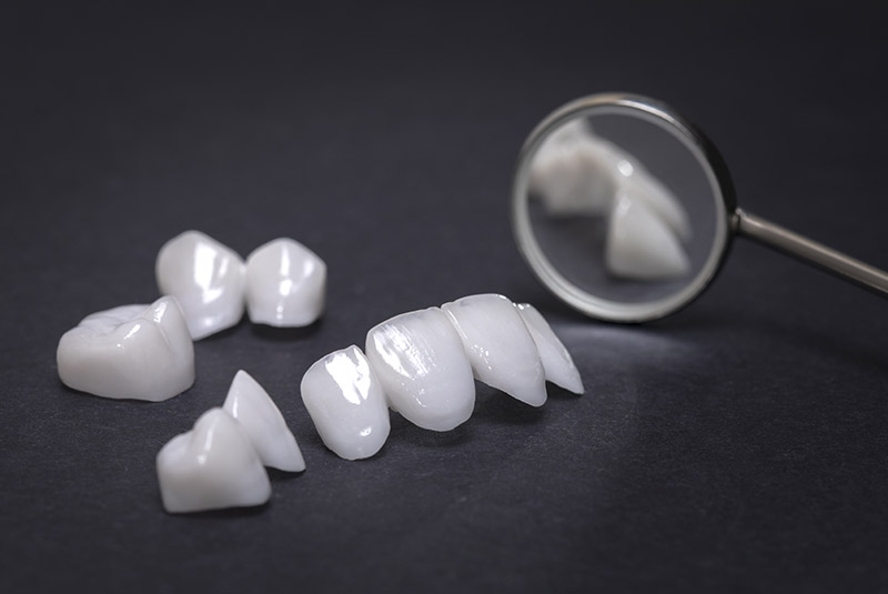 Porcelain veneers example model