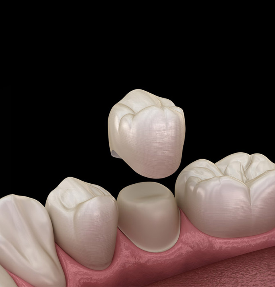 Dental Crown Example model
